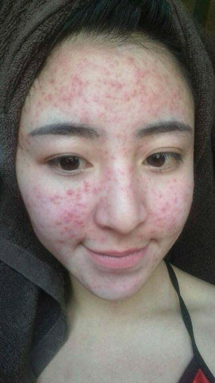 Gương mặt nổi đầy mụn của hot girl bánh tráng trộn. Gương mặt nổi đầy mụn của hot girl bánh tráng trộn.