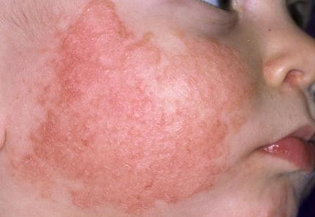 Làm gì để da bé không bị khô khi đông về? - Ảnh 1 Làm gì để da bé không bị khô khi đông về? - Ảnh 1