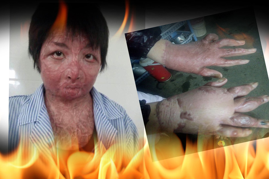 Hai cô gái xinh đẹp bị chồng thiêu sống: Đớn đau tìm lại hình hài tươi sáng - ảnh 5