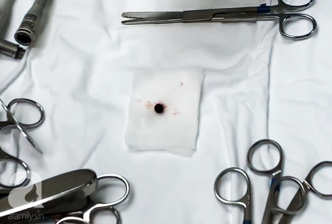 Đang đứng trước cửa nhà, người phụ nữ 32 tuổi bị viên đạn ghim thẳng vào mắt, suýt mù vĩnh viễn-5