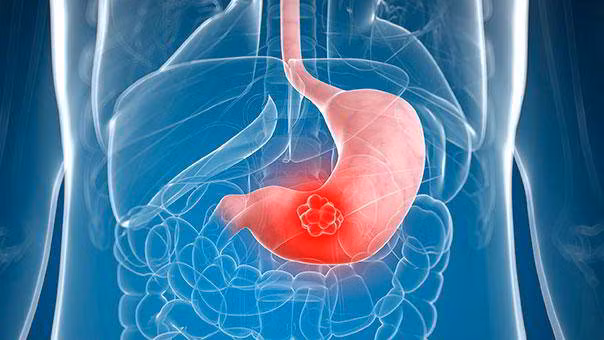 Ung thư dạ dày xếp thứ 3 trong số các bệnh ung thư phổ biến tại Việt Nam nhưng tỷ lệ phát hiện sớm bệnh rất thấp.