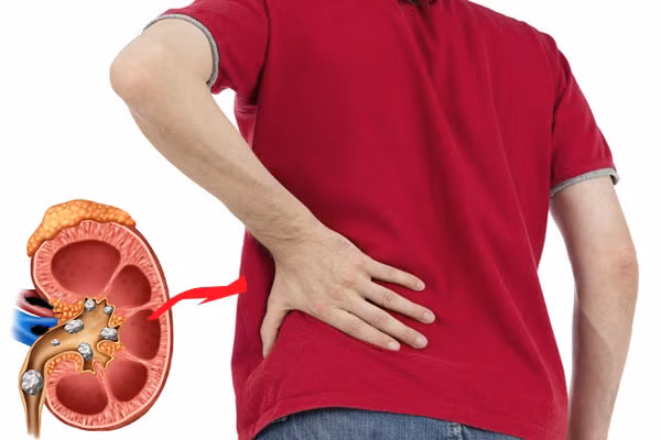 Đau ở phần eo, hông là triệu chứng phổ biến của sỏi thận, đặc biệt là sau khi tập thể dục hoặc vào ban đêm.