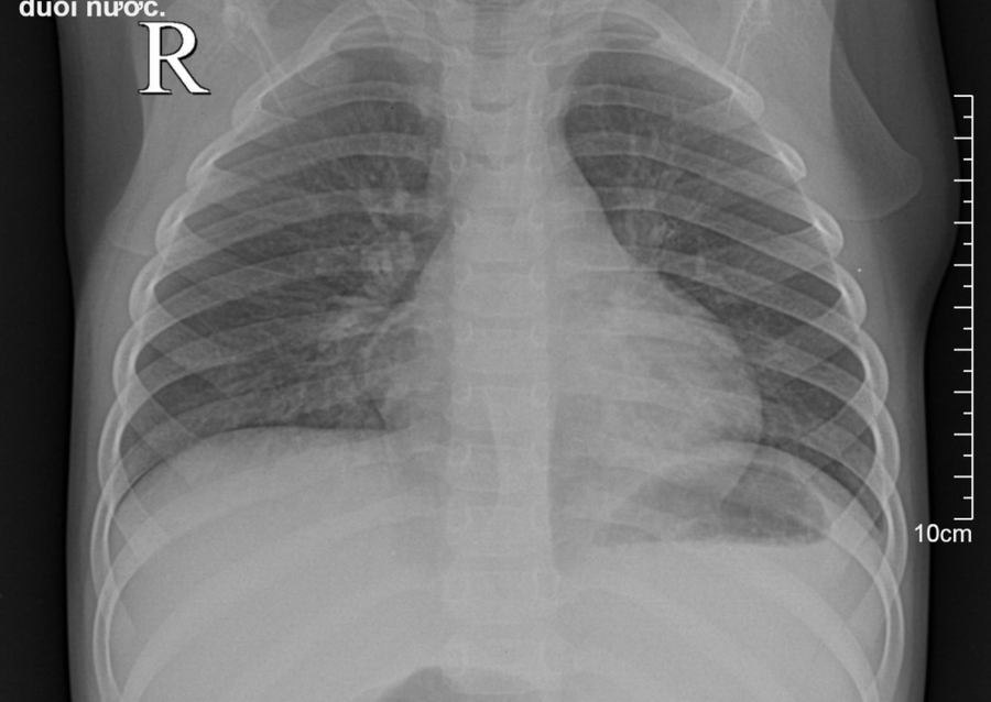 Rơi xuống bể cá nước nổi đầy váng, bệnh nhi 3 tuổi sặc nước viêm phổi