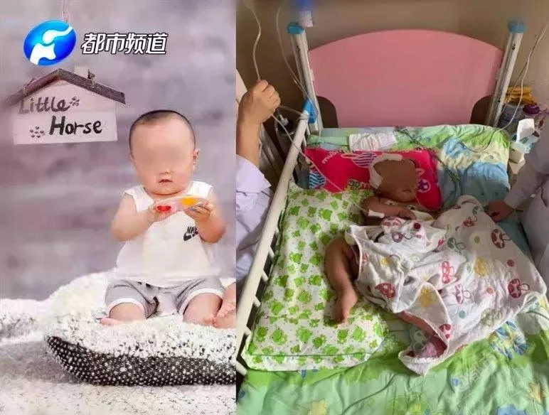 Cậu bé có tên Lele, 16 tháng tuổi bị ngã nhiều lần khi đang tập đi gây tổn thương não. 