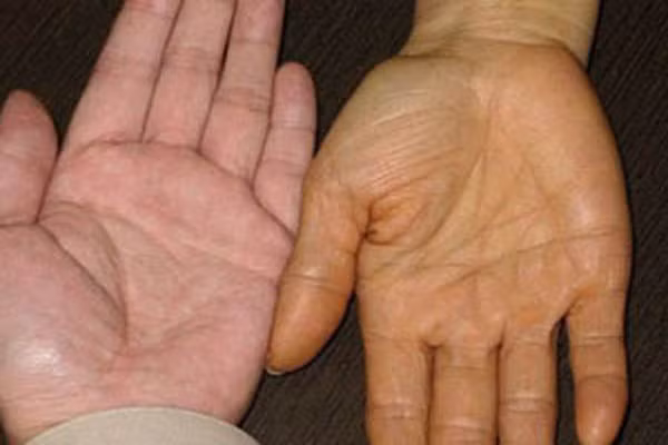 Tay người bình thường và tay người nhiễm caroten cao trong máu.