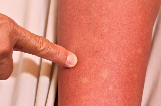 Biểu hiện trên da của người bệnh sốt xuất huyết. Ảnh: BH. Bac si canh bao dau hieu sot xuat huyet can nhap vien ngay hinh anh 2