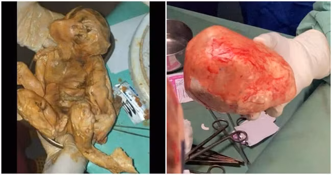 Đau bụng âm ỉ mãi không khỏi, người phụ nữ đi khám và kinh hoàng tột độ khi biết trong bụng mình là thai nhi đã chết 15 năm - Ảnh 2.