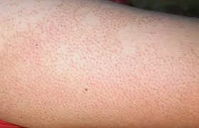 Đề phòng viêm nang lông tái phát