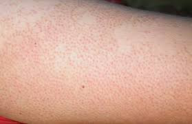 Đề phòng viêm nang lông tái phát