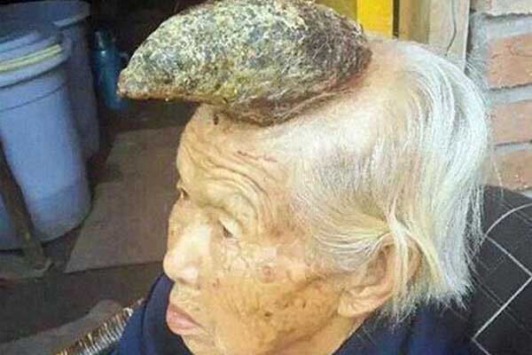 Kinh hãi những căn bệnh ‘quái dị’ nhất thế giới ảnh 2 Kinh hãi những căn bệnh ‘quái dị’ nhất thế giới