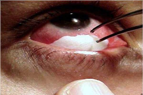 Kinh hãi những căn bệnh ‘quái dị’ nhất thế giới ảnh 1 Kinh hãi những căn bệnh ‘quái dị’ nhất thế giới