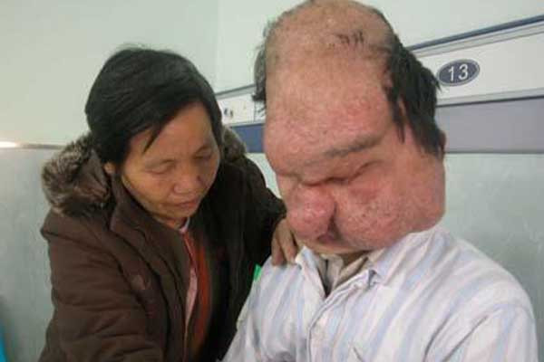 Kinh hãi những căn bệnh ‘quái dị’ nhất thế giới ảnh 7 Kinh hãi những căn bệnh ‘quái dị’ nhất thế giới