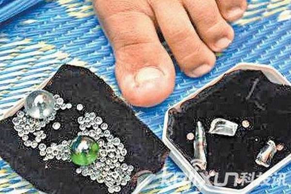 Kinh hãi những căn bệnh ‘quái dị’ nhất thế giới ảnh 8 Kinh hãi những căn bệnh ‘quái dị’ nhất thế giới