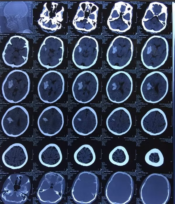 3 giờ mở sọ, cứu sống bệnh nhân 44 tuổi nghiện rượu, xuất huyết não từ cửa tử