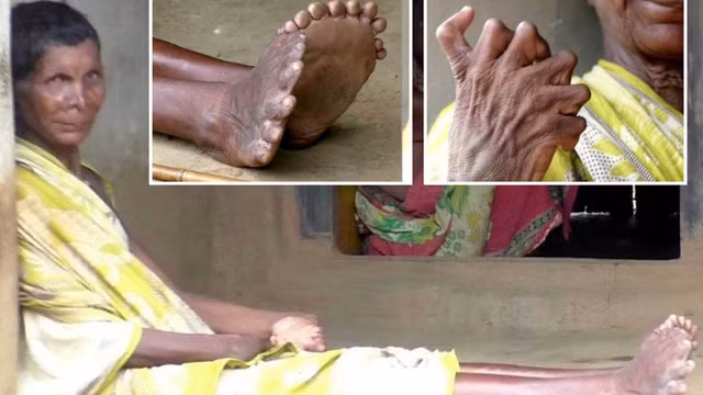 Người phụ nữ có 19 ngón chân, 12 ngón tay bị kỳ thị là "phù thủy"