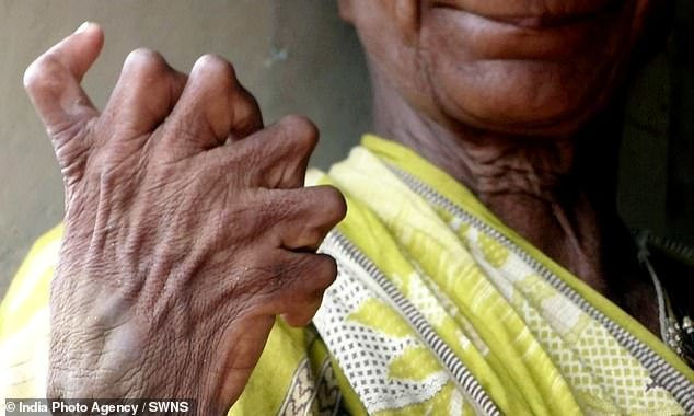 Người phụ nữ có 19 ngón chân, 12 ngón tay bị kỳ thị là "phù thủy" ảnh 2 Bà Nayak có 6 ngón tay vì dị tật thừa ngón.