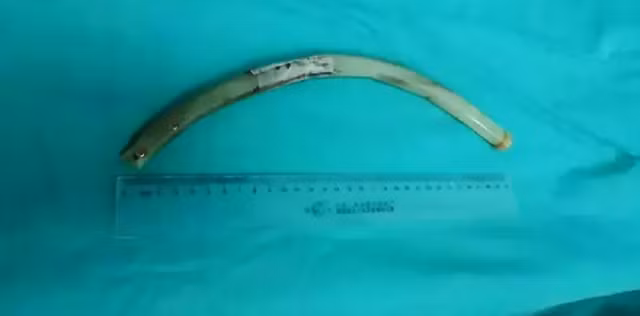 Ống nhựa trong dạ dày nữ bệnh nhân.