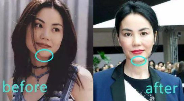 Không chỉ vậy, cằm cô cũng thon, nhọn hơn. Vương Phi lộ nhiều bằng chứng dao kéo - 1