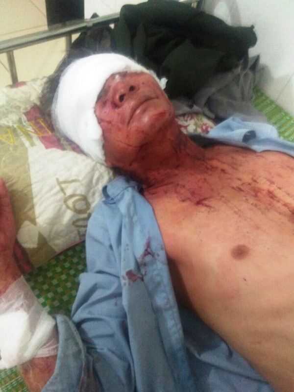 Ông Tô Văn Tùng đang được điều trị tại bệnh viện. Ông Tô Văn Tùng đang được điều trị tại bệnh viện.