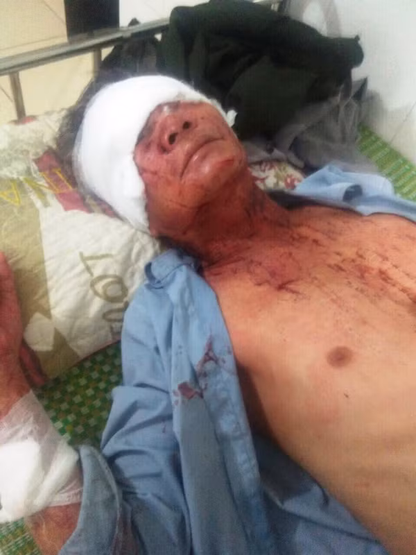 Ông Tô Văn Tùng đang được điều trị tại bệnh viện.