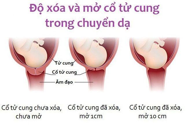 Vì sao cùng là co thắt chuyển dạ mà có mẹ đau đến đứng ngồi không yên, có mẹ lại nhàn tênh?