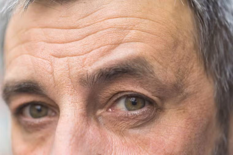 Nếp nhăn gương mặt nói gì về sức khỏe của bạn?