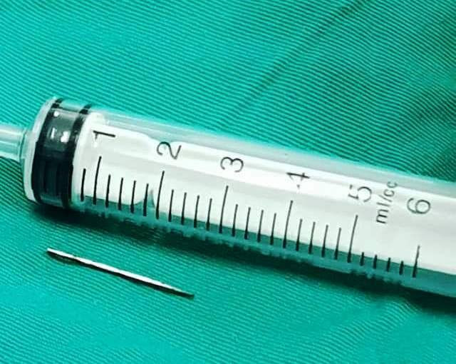 Đoạn kim được bác sĩ lấy ra khỏi tay bệnh nhi. Dị vật là đoạn kim được lấy ra khỏi tay bệnh nhi. Ảnh: Bệnh viện cung cấp.