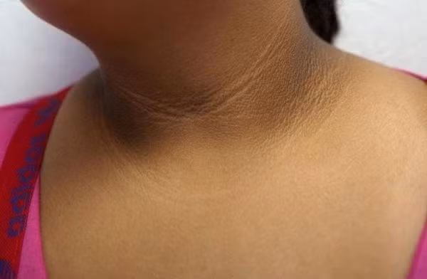 Bé 10 tuổi có vệt đen trên cổ, bác sĩ nói tuy nhẹ nhưng cảnh báo bệnh nguy hiểm hơn