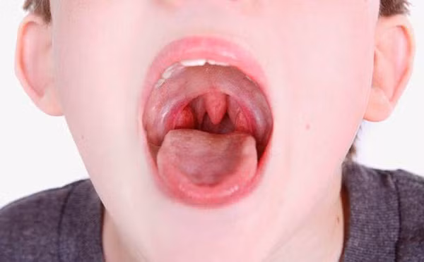 Cậu bé 12 tuổi thường xuyên ngủ ngáy, đi khám phát hiện loại bệnh không ít trẻ có thể mắc-3