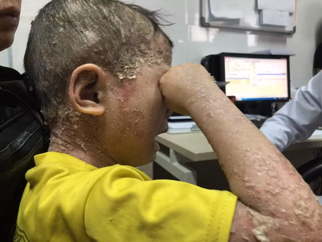 Những mảng bong tróc toàn thân khiến bệnh nhi đau đớn.