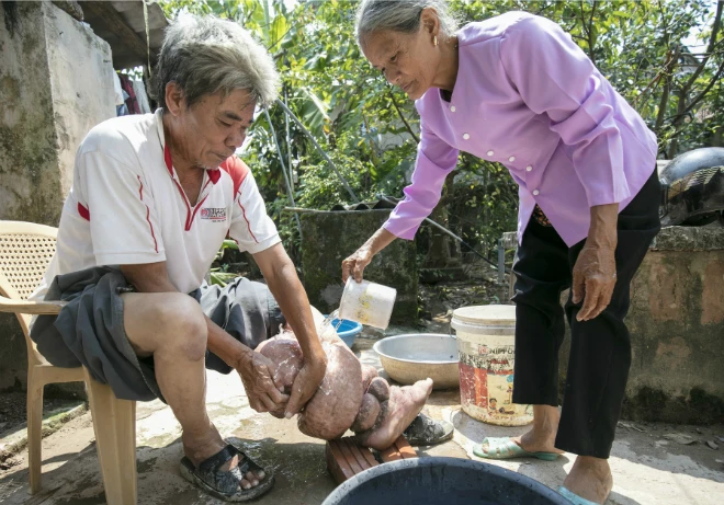 Việt Nam loại trừ được bệnh chân voi