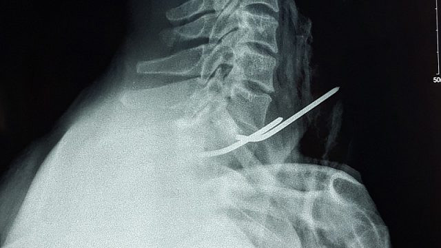 Hy hữu bệnh nhân bị đinh y tế đâm thủng thực quản - Hình 1