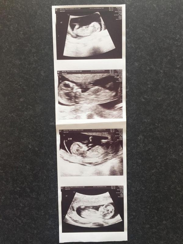 Bfa Tracey đang mang thai 4. Ảnh: SWNS.