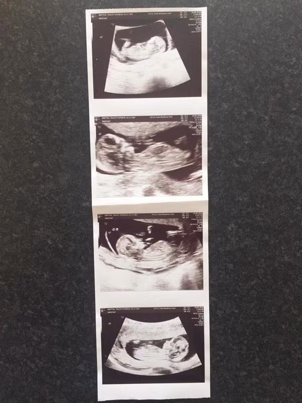 Bfa Tracey đang mang thai 4. Ảnh: SWNS.