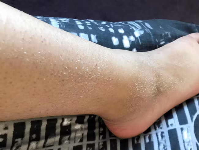 Cô gái 21 tuổi sống khổ sở vì một căn bệnh kỳ lạ hiếm nhưng có thật, chỉ nghe đến thôi đã phải nổi da gà - Ảnh 2.