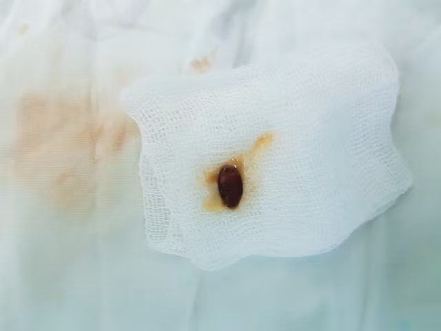 Dị vật là hạt được lấy ra từ cháu bé Nguyễn Bùi Khánh Th.
