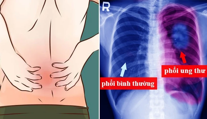 7 dấu hiệu sớm của ung thư phổi rất nhiều người bỏ qua, nguy hiểm nhất là số 5