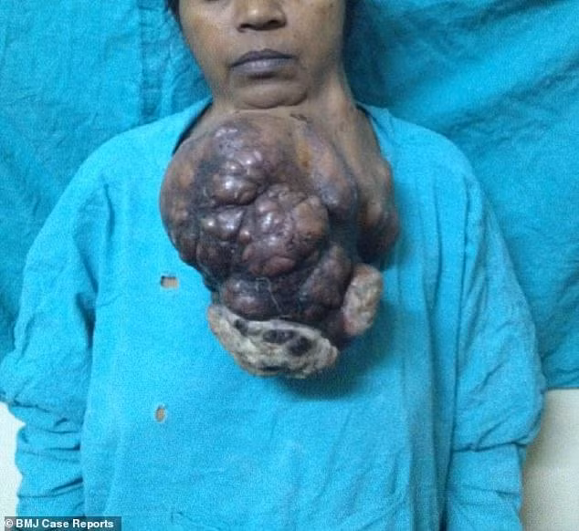 Khối u khủng nặng hơn 4kg