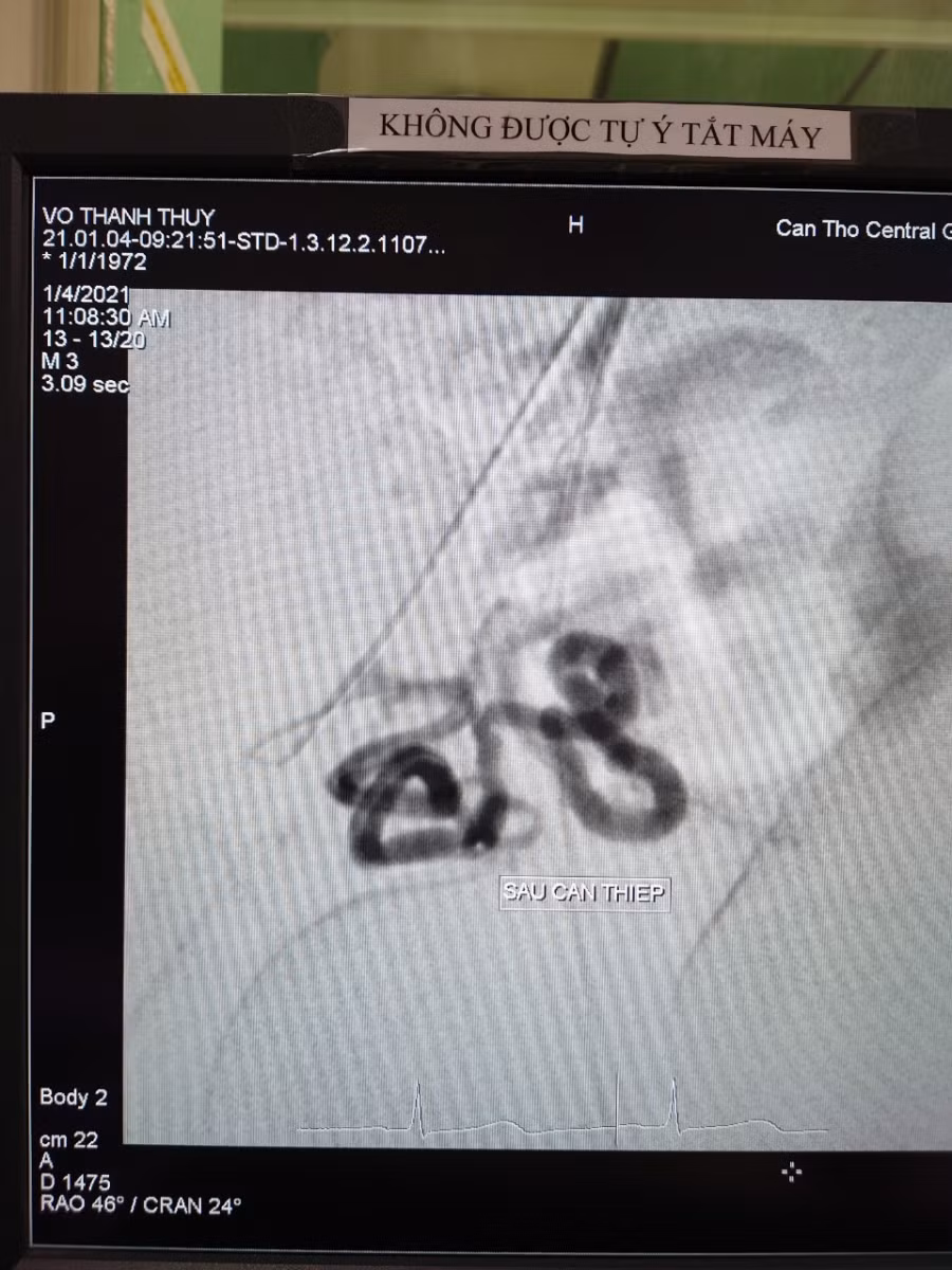 Động mạch tử cung Phải sau can thiệp.