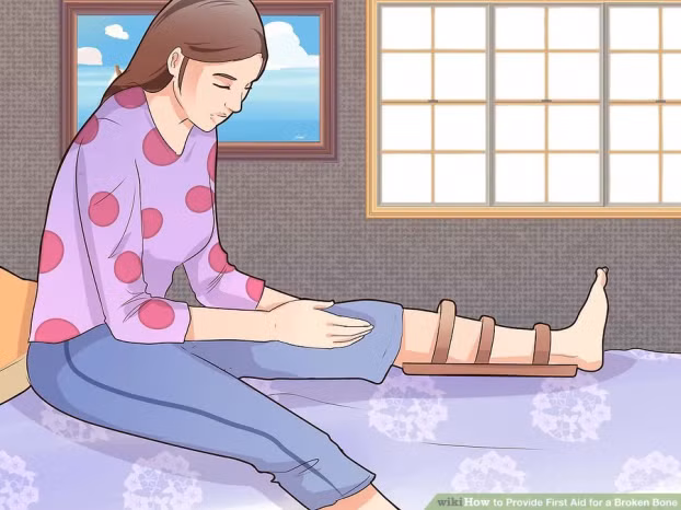 Kỹ năng sơ cứu: Cách sơ cứu khi bị gãy xương nhanh và an toàn nhất 4
