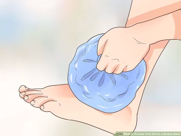 Kỹ năng sơ cứu: Cách sơ cứu khi bị gãy xương nhanh và an toàn nhất 5