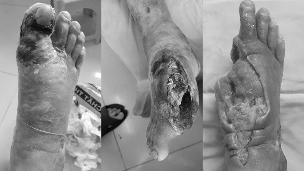 Đái tháo đường,tiểu đường,biến chứng tiểu đường Đái tháo đường,tiểu đường,biến chứng tiểu đường