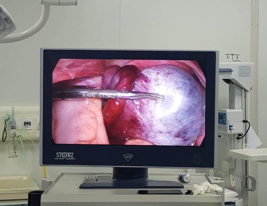 Kỳ lạ khối u mọc răng, da và tóc trong buồng trứng bé gái 12 tuổi