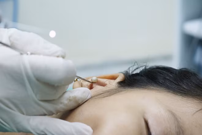 Bé A.T và dị vật trong tai của mình