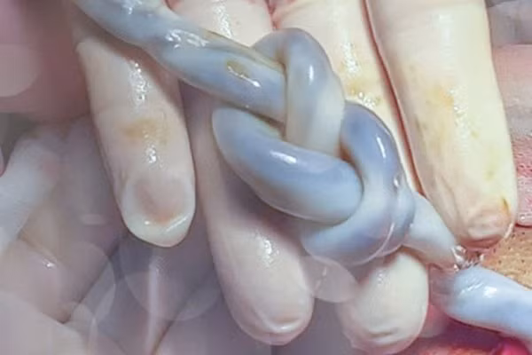 Mổ cấp cứu cho mẹ Cần Thơ, bác sĩ choáng khi thấy thai nhi