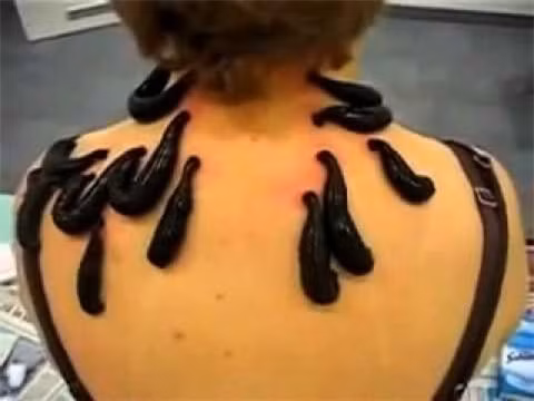 Dùng đỉa, giòi để chữa bệnh