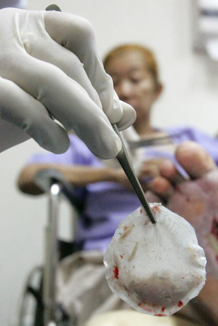 Dùng đỉa, giòi để chữa bệnh ảnh 2