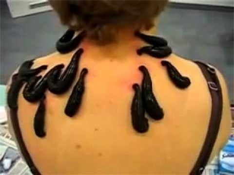 Dùng đỉa, giòi để chữa bệnh ảnh 1