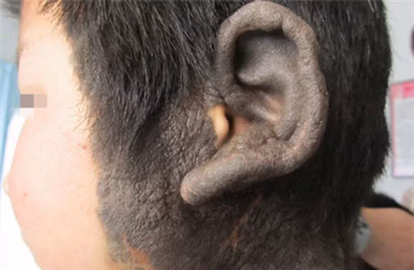 Nơ-vi hắc tố bẩm sinh không phát triển lan ra mà bao phủ vùng da cơ thể tương đương lúc sinh.