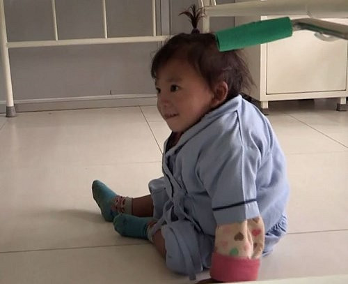 Bé trai Nepal "mọc" cánh tay ở… lưng